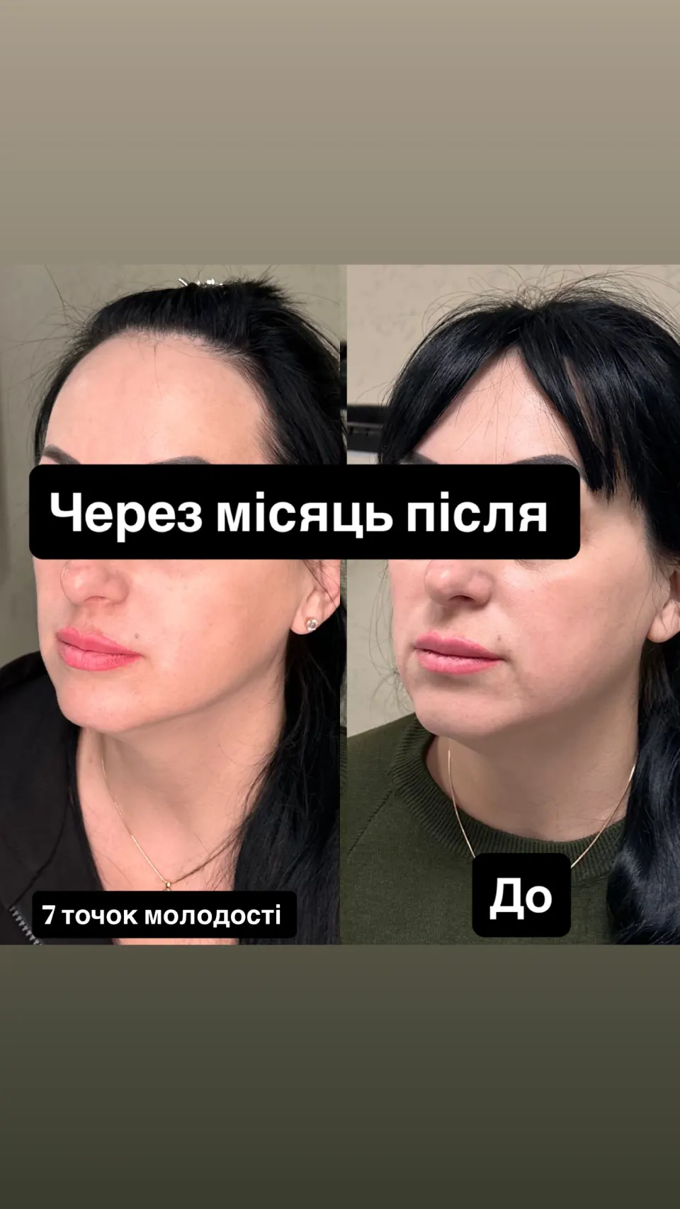 Ліфтинг-процедури — результат до і після