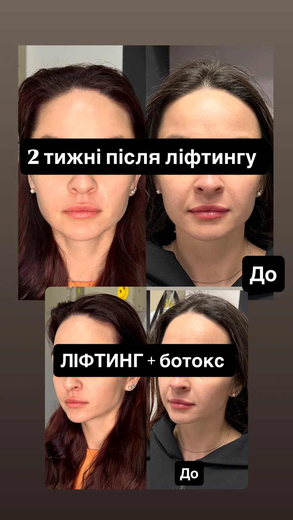 Ліфтинг-процедури — результат до і після