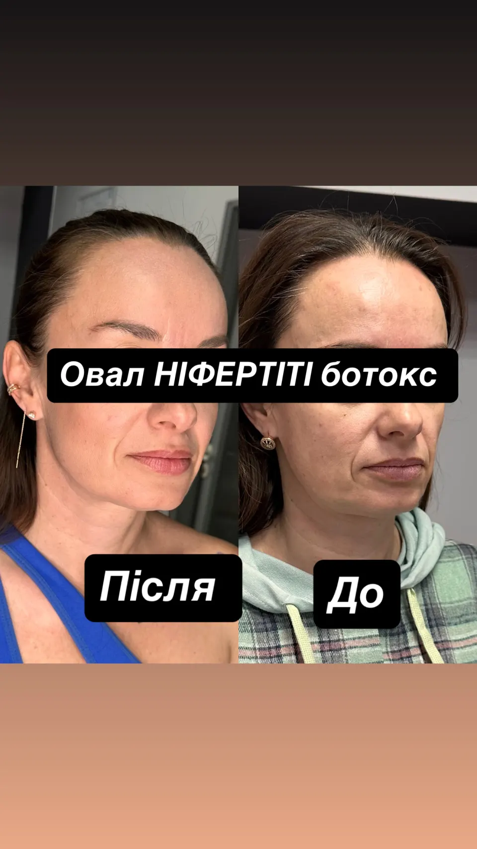 Ботулінотерапія — результат до і після